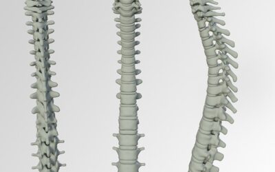 Denosumab Discontinuation and Increased Vertebral Fractures