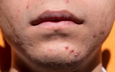 2024 Acne Guidelines – Top 5 Takeaways