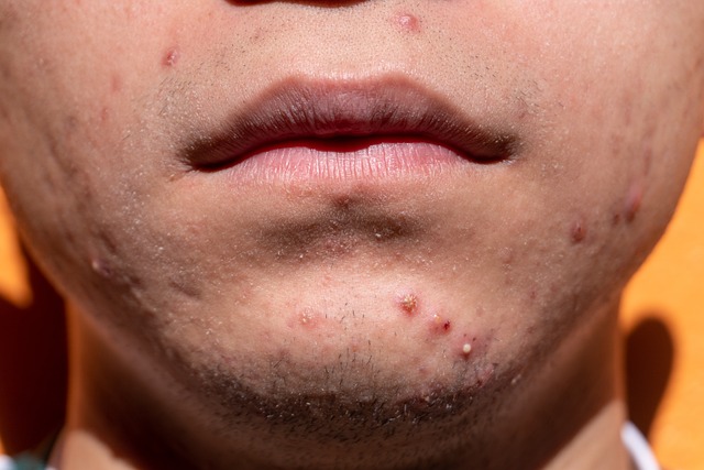 2024 Acne Guidelines – Top 5 Takeaways